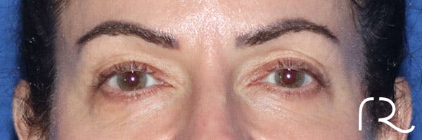 Eyelid Surgery Before & After Gallery - Patient 161583461 - Image 1