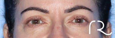 Eyelid Surgery Before & After Gallery - Patient 161583461 - Image 2