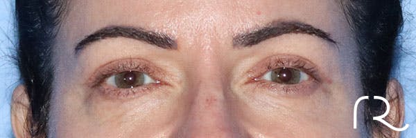 Eyelid Surgery Before & After Gallery - Patient 161583461 - Image 2