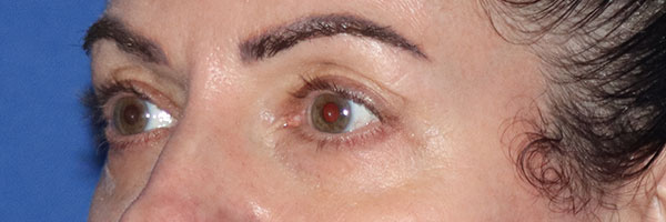 Eyelid Surgery Before & After Gallery - Patient 161583461 - Image 3