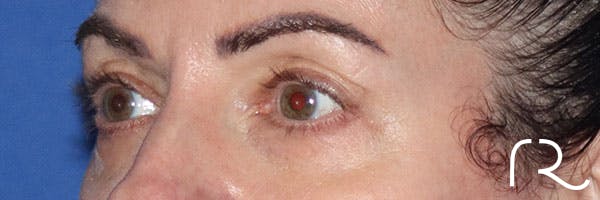 Eyelid Surgery Before & After Gallery - Patient 161583461 - Image 3