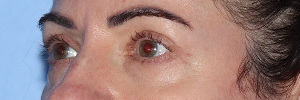 Eyelid Surgery Before & After Gallery - Patient 161583461 - Image 4
