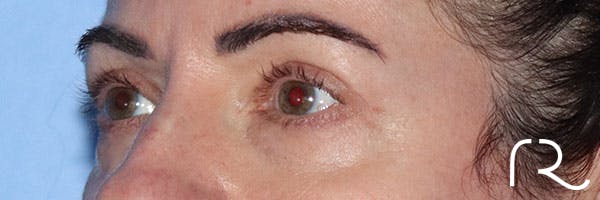 Eyelid Surgery Before & After Gallery - Patient 161583461 - Image 4