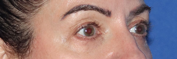 Eyelid Surgery Before & After Gallery - Patient 161583461 - Image 5
