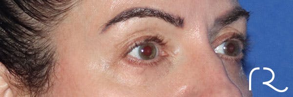 Eyelid Surgery Before & After Gallery - Patient 161583461 - Image 5