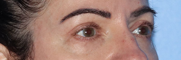 Eyelid Surgery Before & After Gallery - Patient 161583461 - Image 6