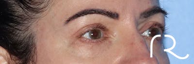 Eyelid Surgery Before & After Gallery - Patient 161583461 - Image 6