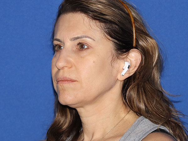 Neck Lift Before & After Gallery - Patient 161584586 - Image 1