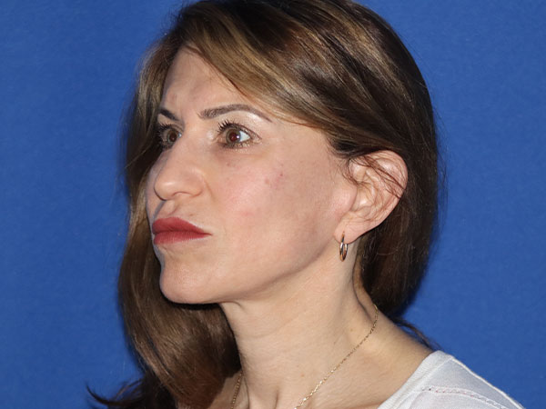 Neck Lift Before & After Gallery - Patient 161584586 - Image 2