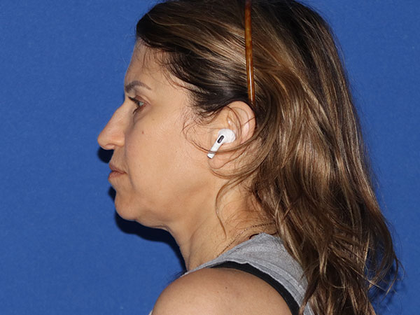 Neck Lift Before & After Gallery - Patient 161584586 - Image 3