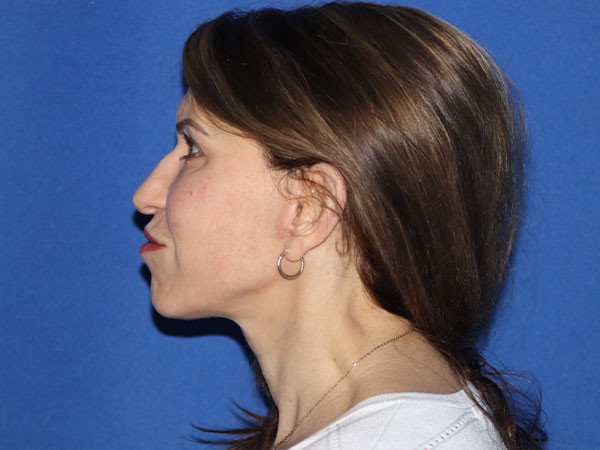 Neck Lift Before & After Gallery - Patient 161584586 - Image 4