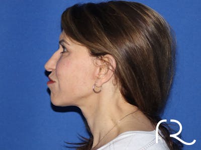 Neck Lift Before & After Gallery - Patient 161584586 - Image 4