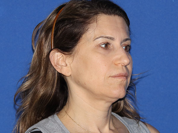 Neck Lift Before & After Gallery - Patient 161584586 - Image 5