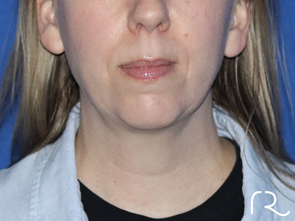 Facelift Before & After Gallery - Patient 161308419 - Image 3