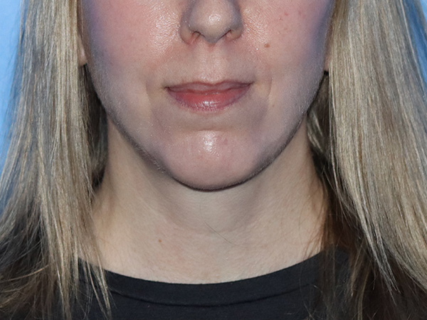 Facelift Before & After Gallery - Patient 161308419 - Image 4