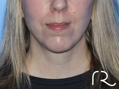 Facelift Before & After Gallery - Patient 161308419 - Image 4