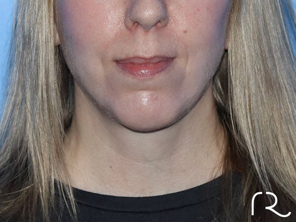 Chin Augmentation  Before & After Gallery - Patient 167807579 - Image 4