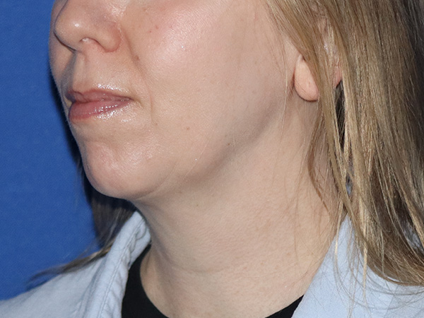 R2 Extended Deep Neck Lift Before & After Gallery - Patient 167807578 - Image 1