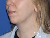 Extended Deep Neck Lift Before & After Gallery - Patient 167807578 - Image 1