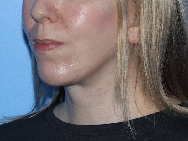 Facelift Before & After Gallery - Patient 161308419 - Image 2