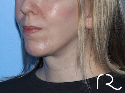 Extended Deep Neck Lift Before & After Gallery - Patient 167807578 - Image 2