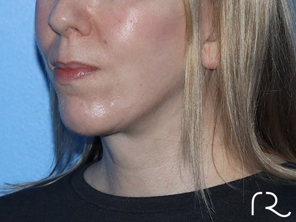 Chin Augmentation  Before & After Gallery - Patient 167807579 - Image 6