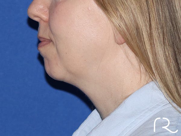 Chin Augmentation  Before & After Gallery - Patient 167807579 - Image 1