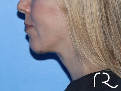 Chin Augmentation  Before & After Gallery - Patient 167807579 - Image 2