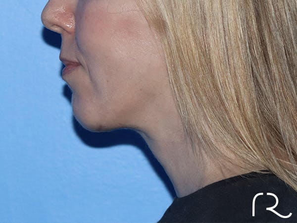 Chin Augmentation  Before & After Gallery - Patient 167807579 - Image 2