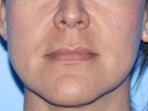 Lip Lift Before & After Gallery - Patient 168494134 - Image 1