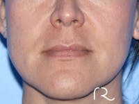 Lip Lift Before & After Gallery - Patient 168494134 - Image 1