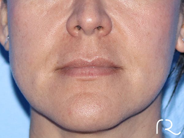 Lip Lift Before & After Gallery - Patient 168494134 - Image 1