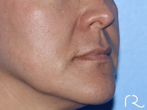 Lip Lift Before & After Gallery - Patient 168494134 - Image 3