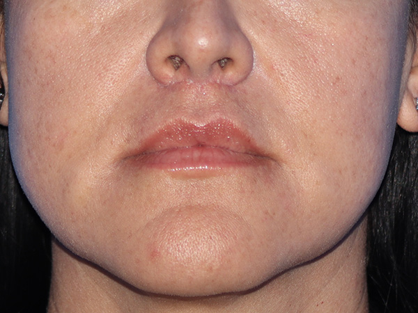 Lip Lift Before & After Gallery - Patient 168494134 - Image 2