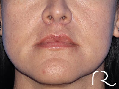 Lip Lift Before & After Gallery - Patient 168494134 - Image 2