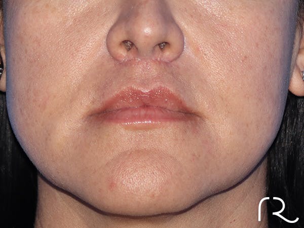 Lip Lift Before & After Gallery - Patient 168494134 - Image 2