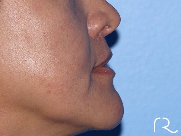 Lip Lift Before & After Gallery - Patient 168494134 - Image 6