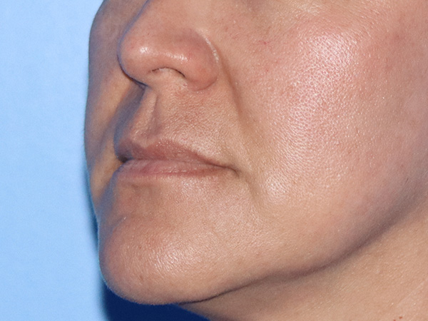 Lip Lift Before & After Gallery - Patient 168494134 - Image 7