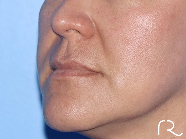 Lip Lift Before & After Gallery - Patient 168494134 - Image 7