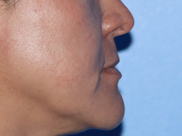 Lip Lift Before & After Gallery - Patient 168494134 - Image 5