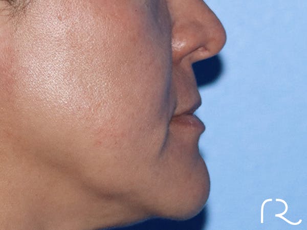 Lip Lift Before & After Gallery - Patient 168494134 - Image 5