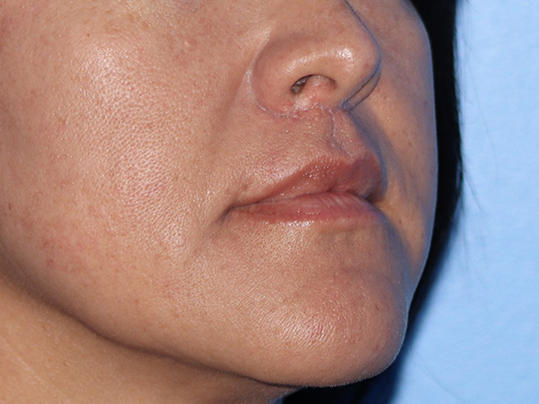 Lip Lift Before & After Gallery - Patient 168494134 - Image 4