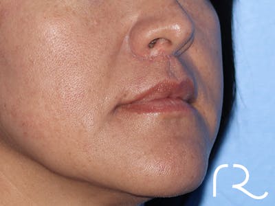 Lip Lift Before & After Gallery - Patient 168494134 - Image 4