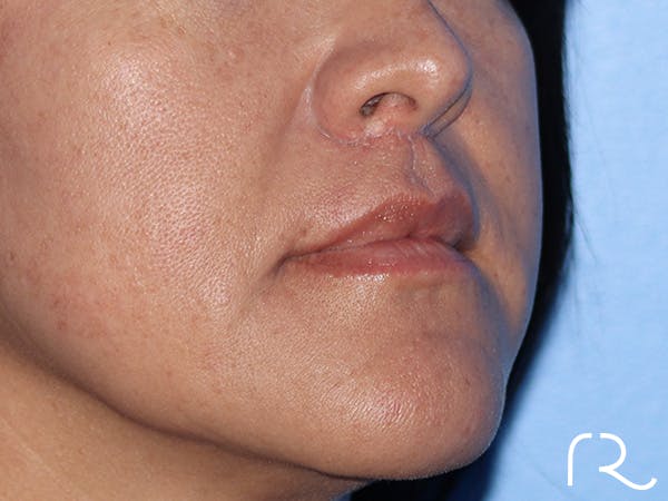 Lip Lift Before & After Gallery - Patient 168494134 - Image 4