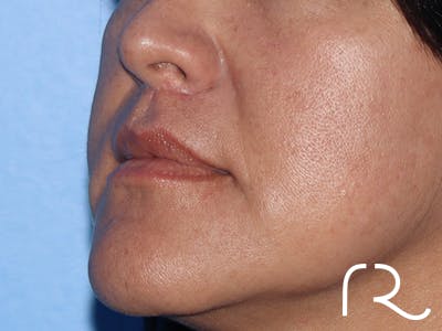 Lip Lift Before & After Gallery - Patient 168494134 - Image 8
