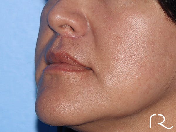 Lip Lift Before & After Gallery - Patient 168494134 - Image 8