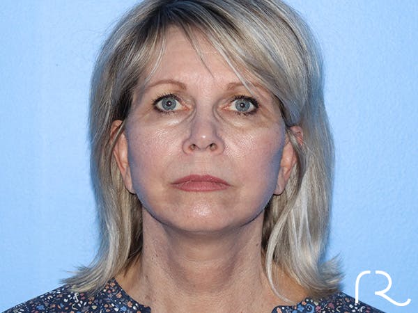 Facelift Before & After Gallery - Patient 168494161 - Image 4