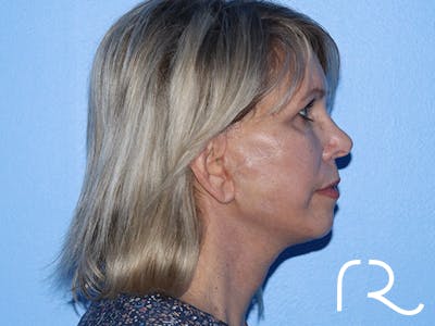 Neck Lift Before & After Gallery - Patient 168494163 - Image 6