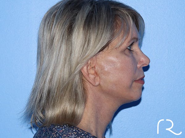 Facelift Before & After Gallery - Patient 168494161 - Image 6