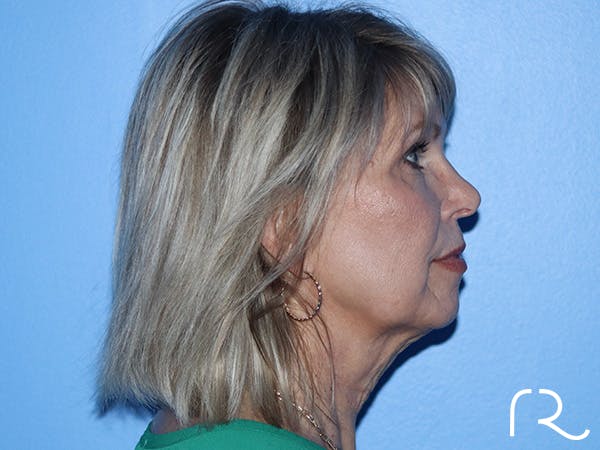 Facelift Before & After Gallery - Patient 168494161 - Image 5